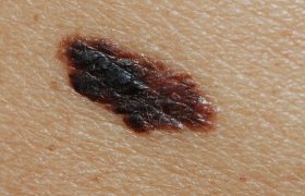 1.-Melanoma